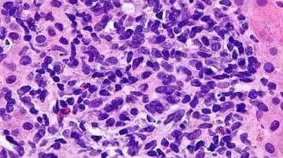 Antibodies found in natural controllers, mutation in virus structure can help control Hepatitis B, studies show